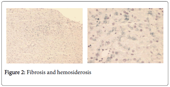 gastrointestinal-digestive-Fibrosis-hemosiderosis