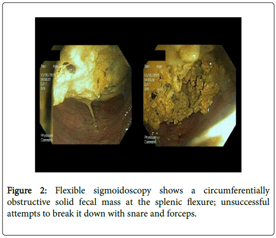 gastrointestinal-digestive-Flexible-sigmoidoscopy