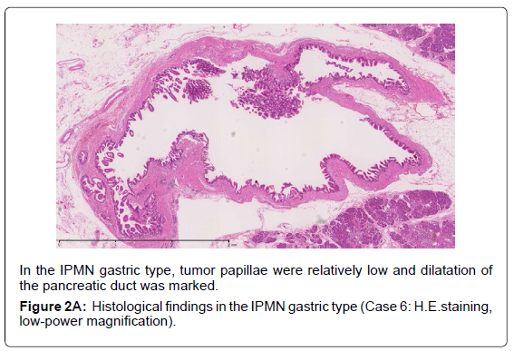 gastrointestinal-digestive-IPMN-gastric-type
