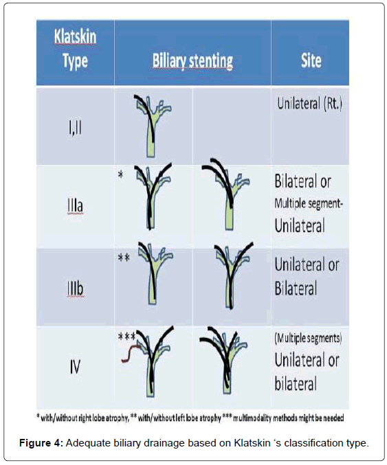 gastrointestinal-digestive-Klatskin-classification-type