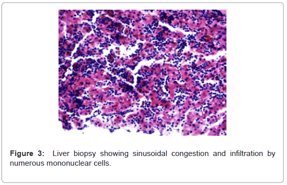 gastrointestinal-digestive-Liver-biopsy-showing