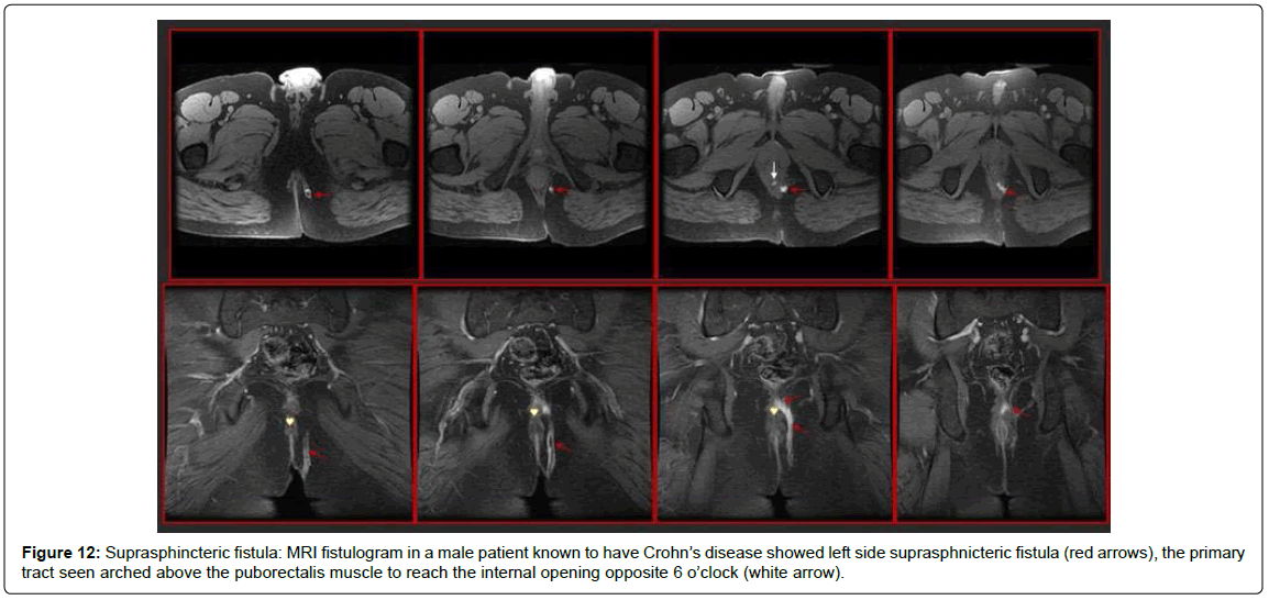 gastrointestinal-digestive-MRI-fistulogram-male