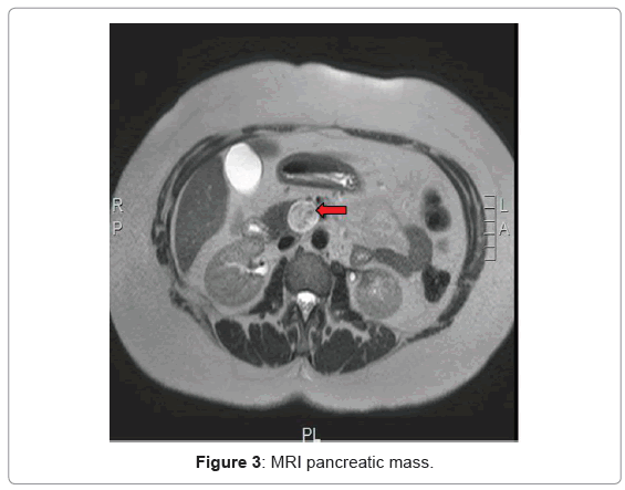 gastrointestinal-digestive-MRI-pancreatic-mass