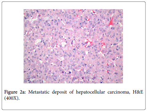 gastrointestinal-digestive-Metastatic-deposit