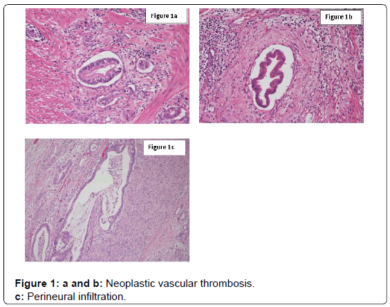 gastrointestinal-digestive-Neoplastic-vascular