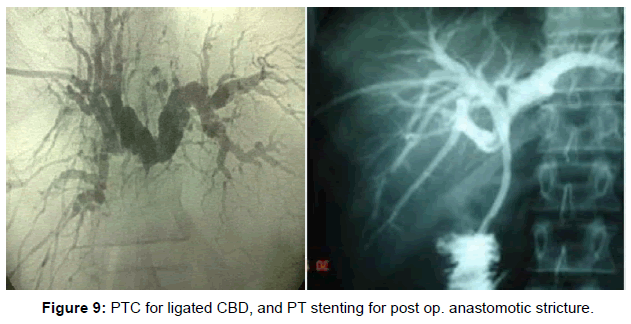 gastrointestinal-digestive-PTC-ligated-CBD-PT