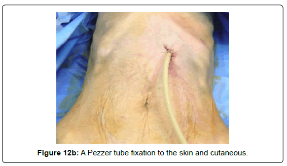 gastrointestinal-digestive-Pezzer-tube-fixation