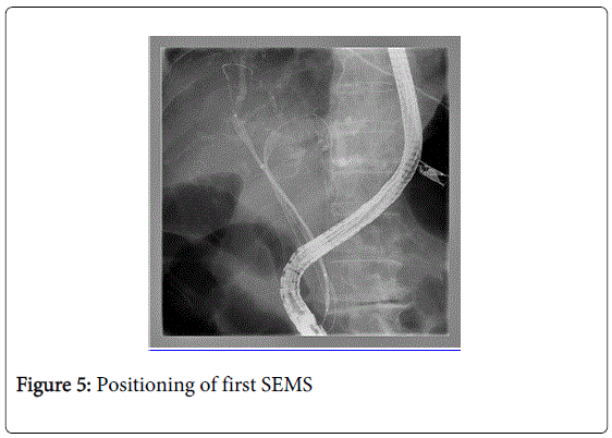 gastrointestinal-digestive-Positioning-first-SEMS