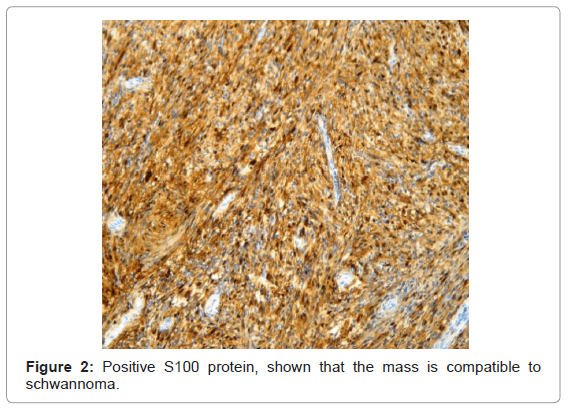 gastrointestinal-digestive-Positive-S100-protein