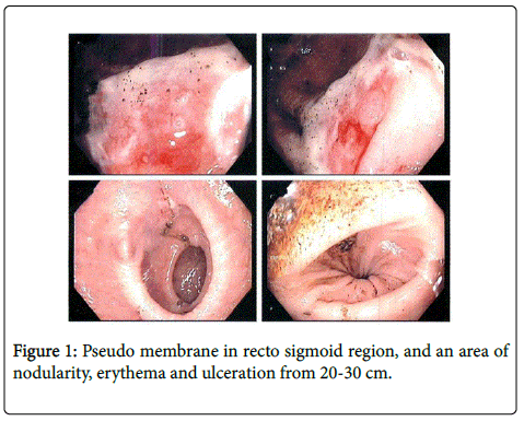 gastrointestinal-digestive-Pseudo-membrane