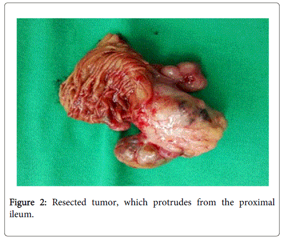 gastrointestinal-digestive-Resected-tumor