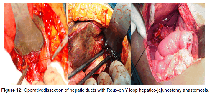 gastrointestinal-digestive-Roux-en-Y-loop-hepatico