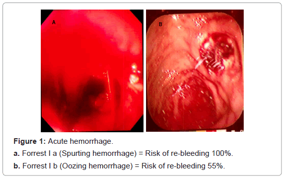 gastrointestinal-digestive-Spurting-hemorrhage