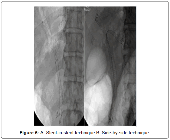 gastrointestinal-digestive-Stent-in-sten--technique