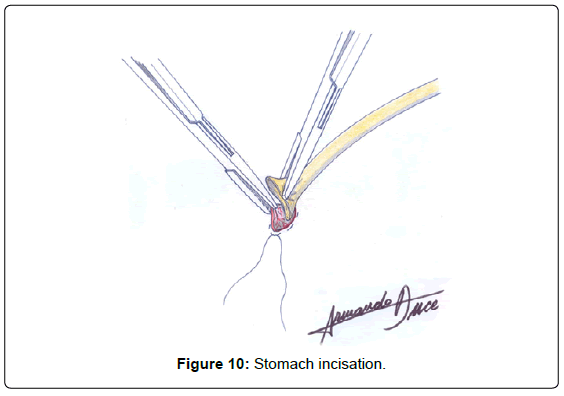 gastrointestinal-digestive-Stomach-incisation