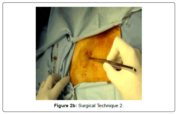 gastrointestinal-digestive-Surgical-Technique