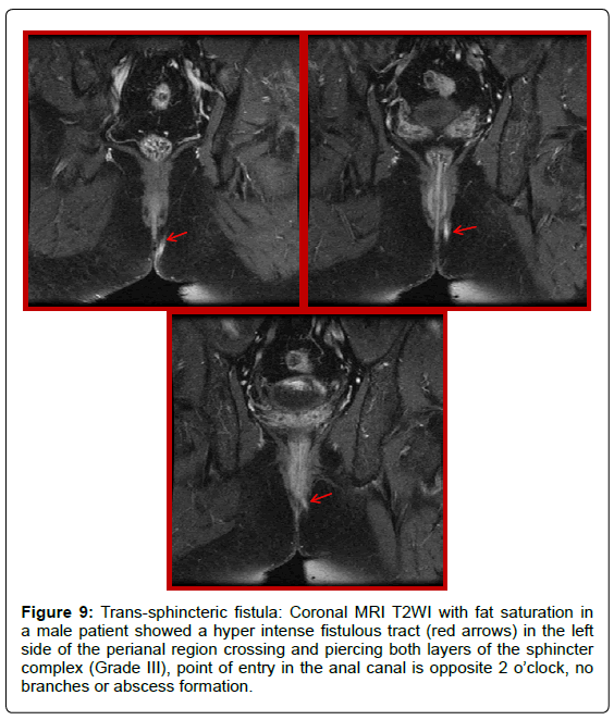 gastrointestinal-digestive-Trans-sphincteric-fistula