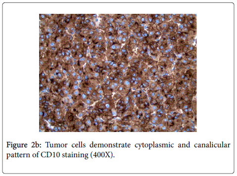 gastrointestinal-digestive-Tumor-cells