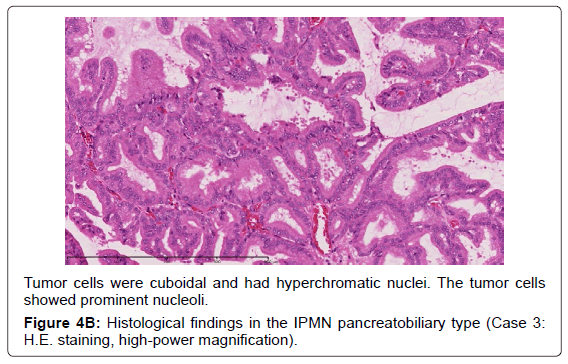 gastrointestinal-digestive-Tumor-cells-cuboidal