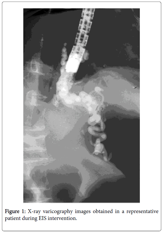 gastrointestinal-digestive-X-ray-varicography-images