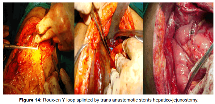 gastrointestinal-digestive-Y-loop-splinted