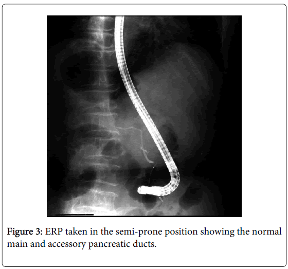 gastrointestinal-digestive-accessory-pancreatic-ducts