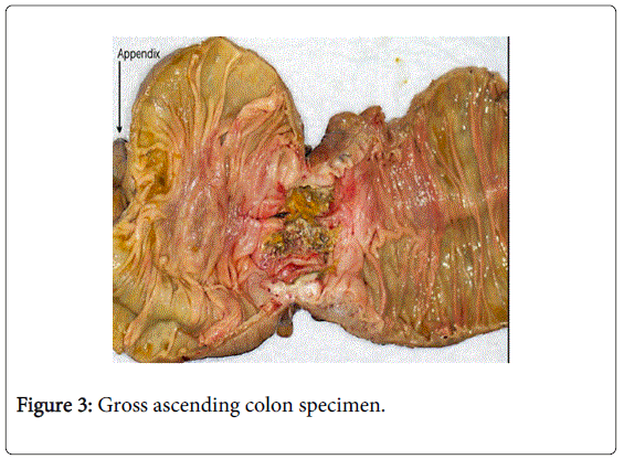 gastrointestinal-digestive-ascending-colon-specimen