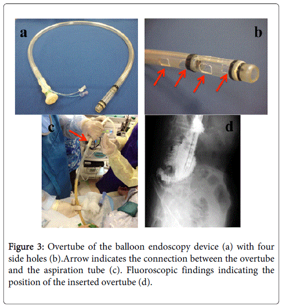 gastrointestinal-digestive-balloon-endoscopy-device