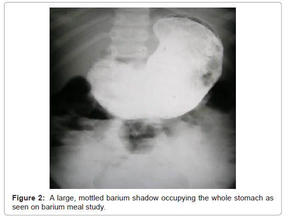 gastrointestinal-digestive-barium-shadow-occupying