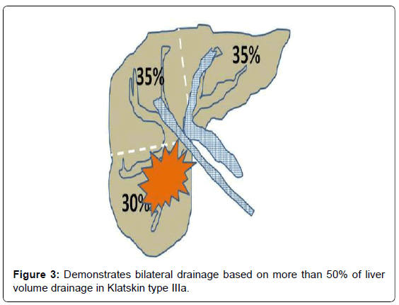 gastrointestinal-digestive-bilateral-drainage-based