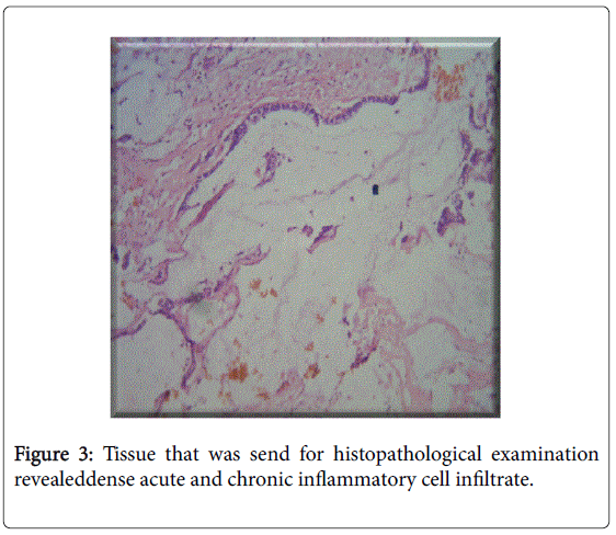 gastrointestinal-digestive-chronic-inflammatory-cell