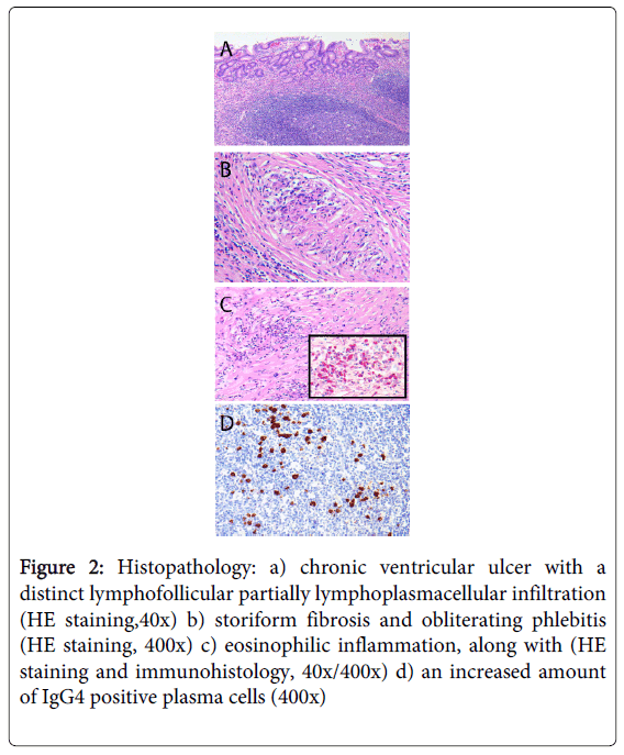 gastrointestinal-digestive-chronic-ventricular-ulcer