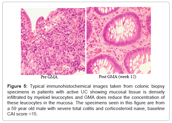 gastrointestinal-digestive-colitis-corticosteroid-naive