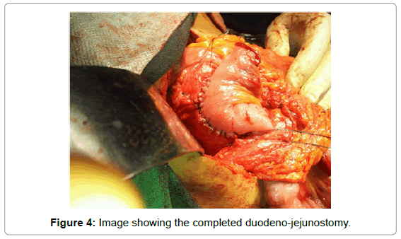gastrointestinal-digestive-completed-duodeno-jejunostomy