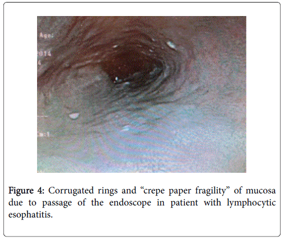 gastrointestinal-digestive-crepe-paper-fragility