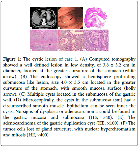 gastrointestinal-digestive-cystic-lesion-case