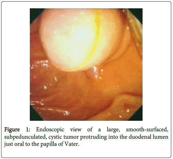 gastrointestinal-digestive-cystic-tumor-protruding