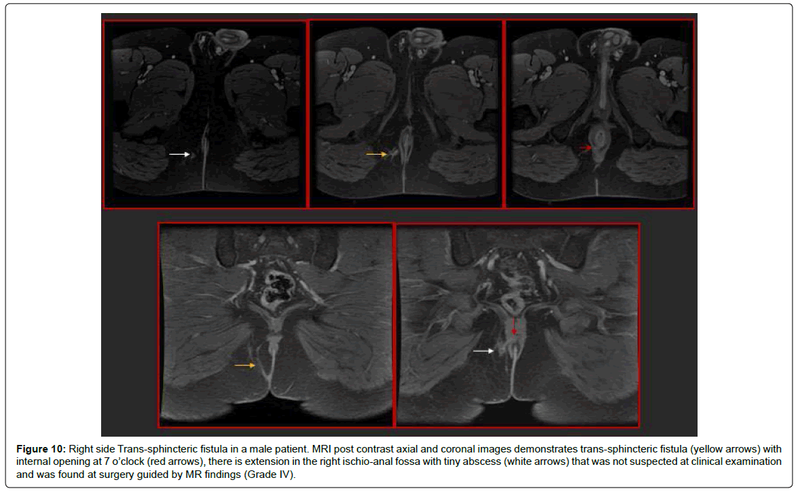 gastrointestinal-digestive-demonstrates-trans-sphincteric-fistula