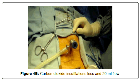 gastrointestinal-digestive-dioxide-insufflations-less
