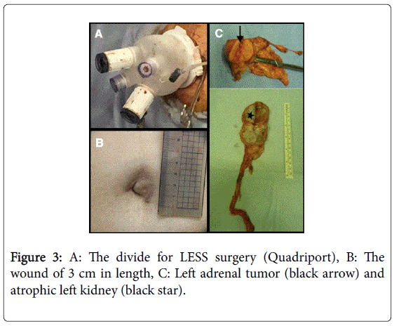 gastrointestinal-digestive-divide-LESS-surgery