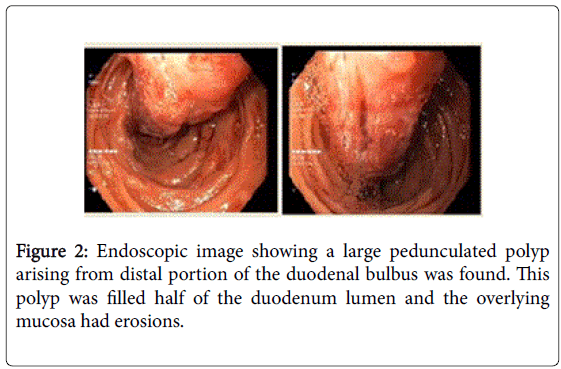 gastrointestinal-digestive-duodenal-bulbus-found