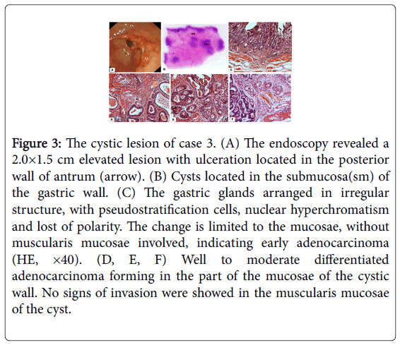 gastrointestinal-digestive-elevated-lesion-ulceration