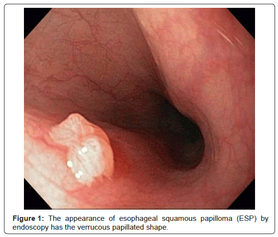 human papilloma virus in esophagus)