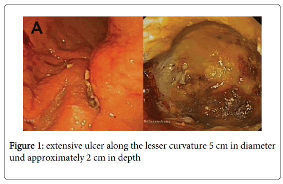 gastrointestinal-digestive-extensive-ulcer
