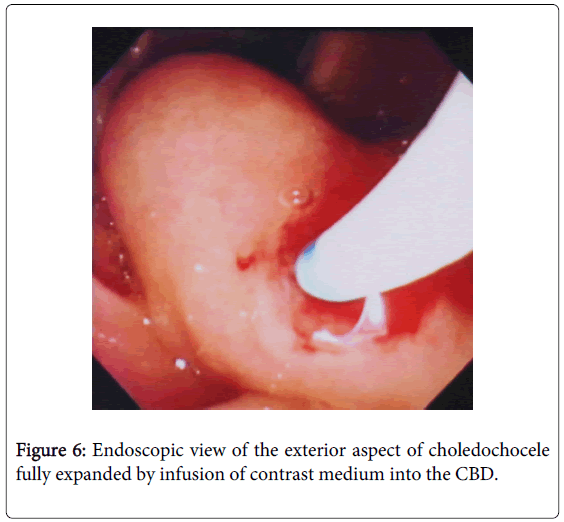 gastrointestinal-digestive-exterior-aspect-choledochocele