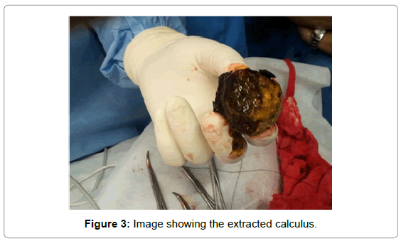 gastrointestinal-digestive-extracted-calculus