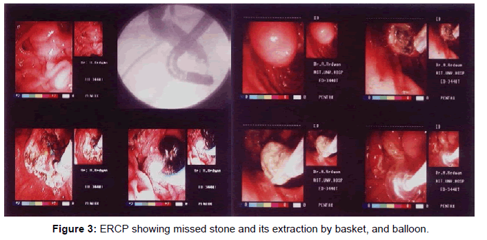 gastrointestinal-digestive-extraction-basket-balloon