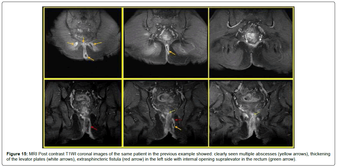 gastrointestinal-digestive-extrasphincteric-fistula