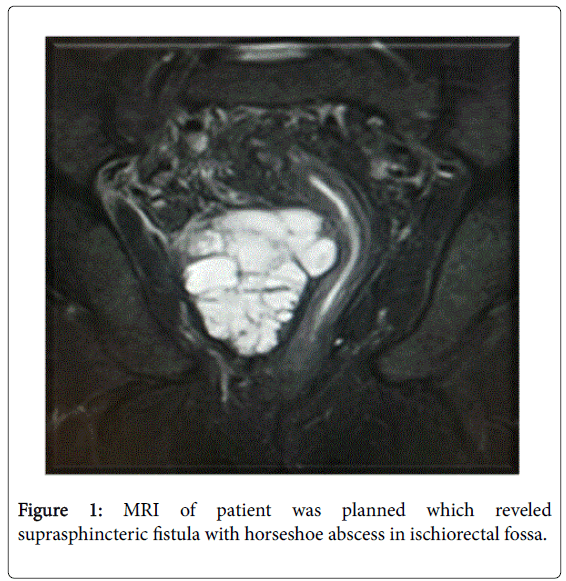 gastrointestinal-digestive-fistula-horseshoe-abscess