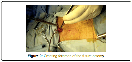 gastrointestinal-digestive-future-ostomy